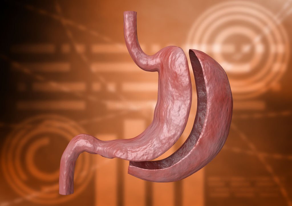 Sleeve: como funciona essa técnica da cirurgia bariátrica?