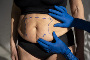 Alimentação após a cirurgia metabólica: o que você precisa saber.